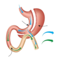 Single Anastomosis Sleeve Ileal bypass (SASI)
