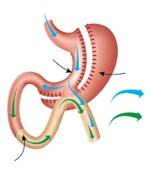 Single Anastomosis Sleeve Ileal bypass (SASI)